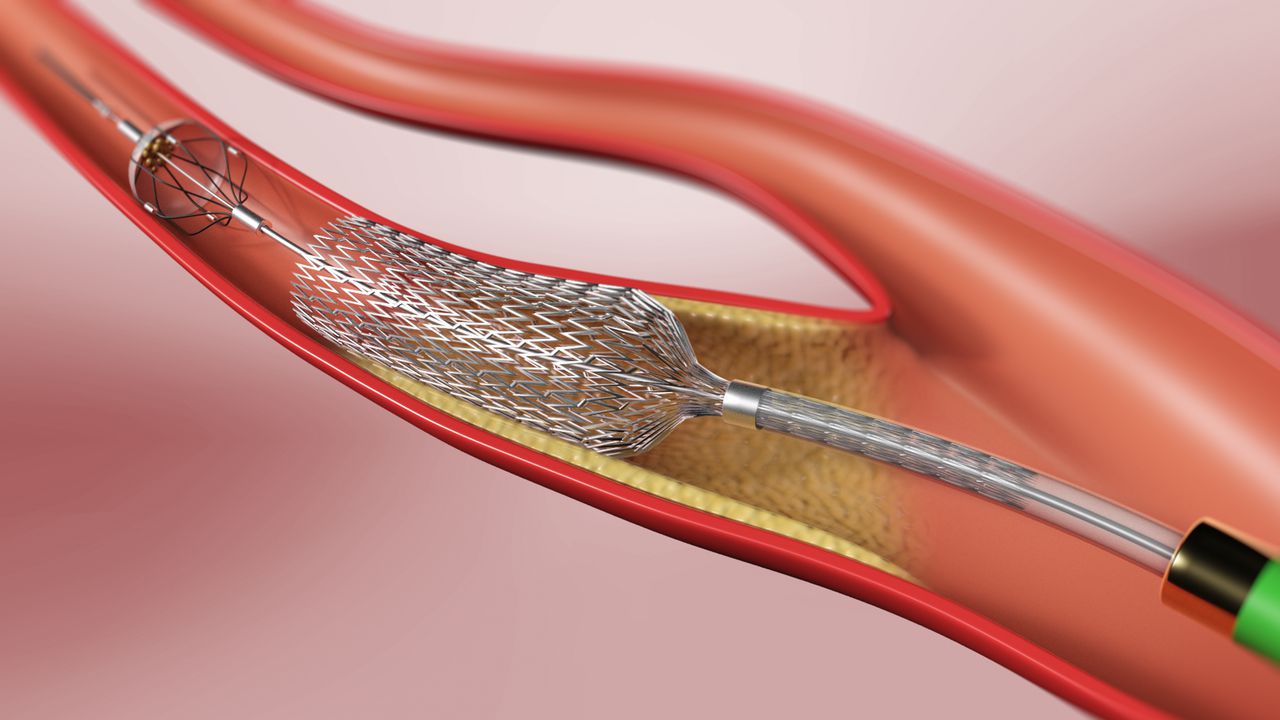 Karotis-Stenting