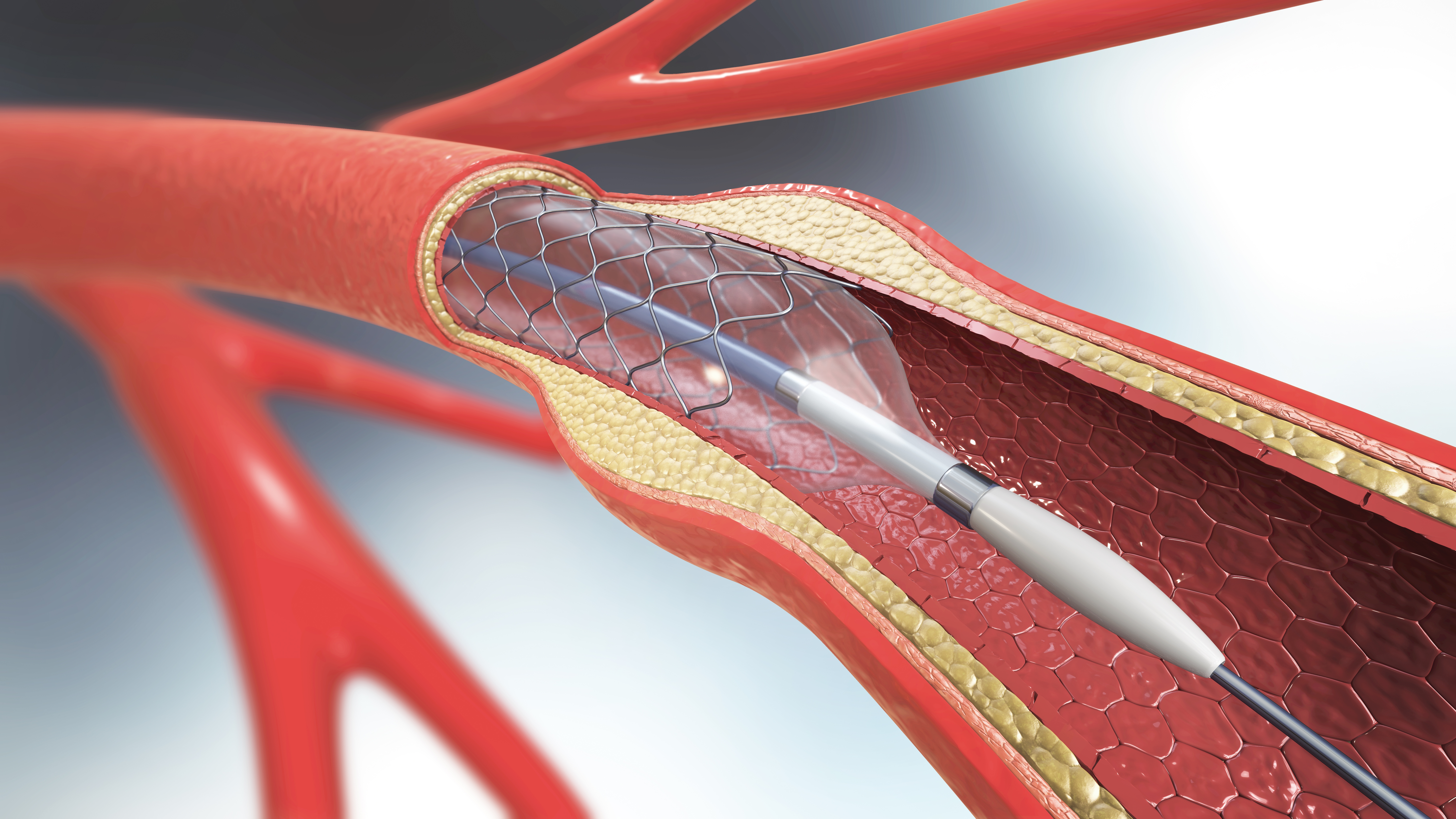 Koronare Ballondilatation und Stentimplantation