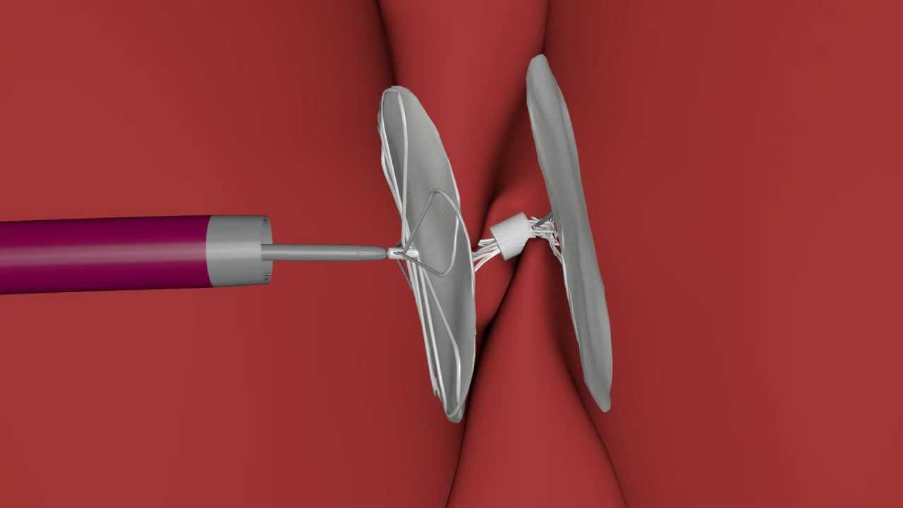 PFO Closure