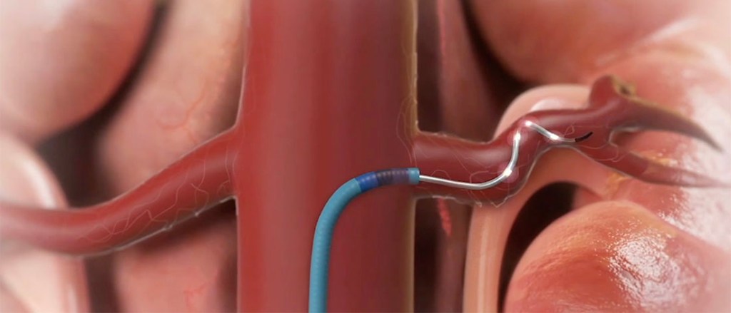 Renale Denervation